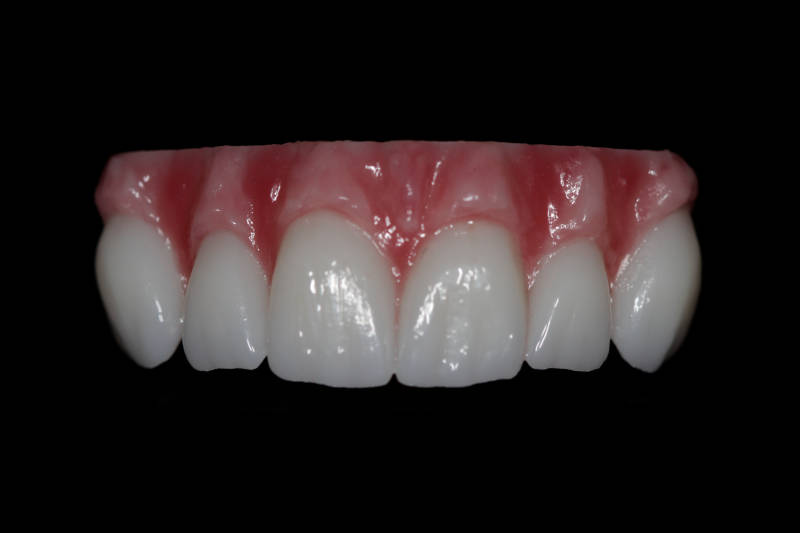 Full Arch Zirconia Bridge