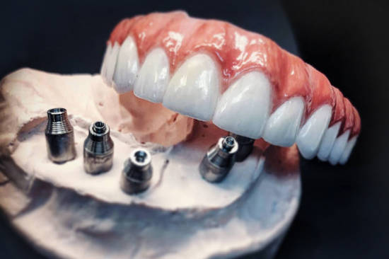 Hybrid Implant Prosthesis